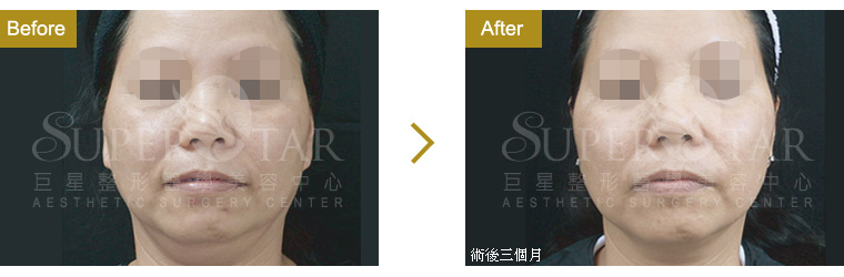 Thermage CPT 電波拉皮 CPT DC黃金探頭電波拉皮