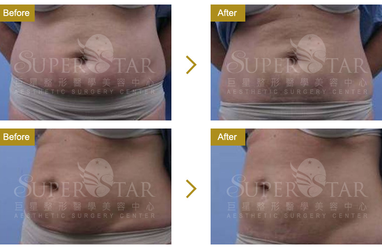 Thermage CPT DC 電波拉皮 Thermage CPT DC 電波拉皮