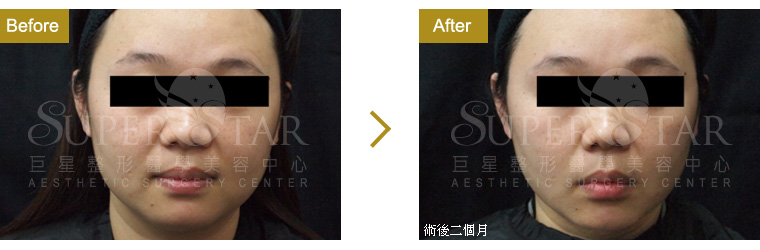 CPT DC黃金探頭電波拉皮 CPT DC黃金探頭電波拉皮