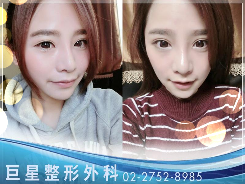 三段式隆鼻 三段式隆鼻