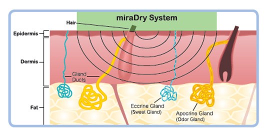 微波頻率維持5.8GHz,能量精準傳遞的目標為真皮與脂肪交接處(dermal-fat interface region) -汗腺分布的區域,與皮膚厚度無關 微波頻率維持5.8GHz,能量精準傳遞的目標為真皮與脂肪交接處(dermal-fat interface region) -汗腺分布的區域,與皮膚厚度無關