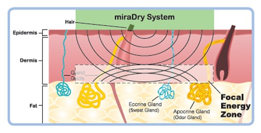 能量聚集於特定區域,與皮膚厚度無關,能量會聚集於汗腺及大汗腺分佈的區域 能量聚集於特定區域,與皮膚厚度無關,能量會聚集於汗腺及大汗腺分佈的區域