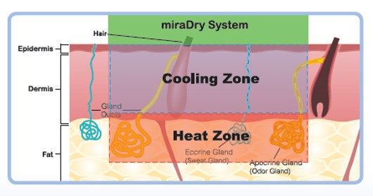 能量治療溫度維持60℃,使汗腺萎縮不再新生,維持持續性效果。 能量治療溫度維持60℃,使汗腺萎縮不再新生,維持持續性效果。