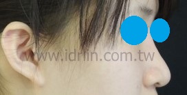 X5韓式隆鼻成果 X5韓式隆鼻成果