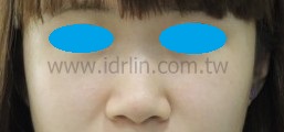 X5韓式隆鼻術前