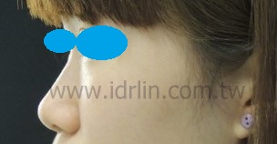 X5韓式隆鼻術前