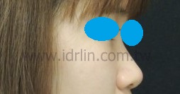 X5韓式隆鼻術前