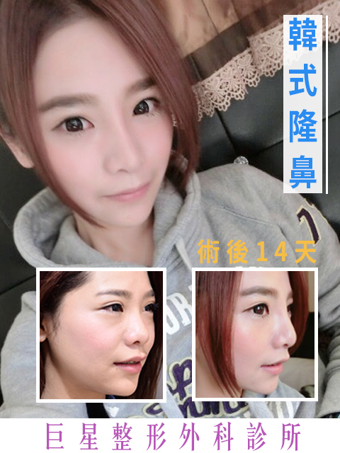 韓式隆鼻 韓式隆鼻