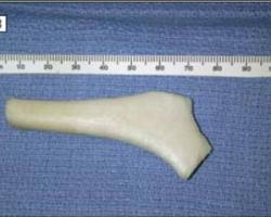 人工肋骨韓式隆鼻 人工肋骨韓式隆鼻