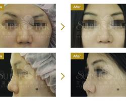 人工骨韓式隆鼻
