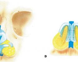 人工骨 韓式隆鼻