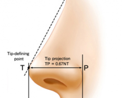 隆鼻手術成功的要件
