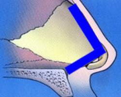 全自體肋骨 韓式隆鼻 全自體肋骨 韓式隆鼻