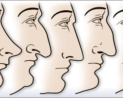 台灣人常見的隆鼻鼻型