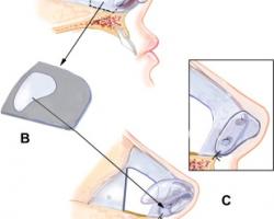 適合台灣人的韓式隆鼻–ESG韓式隆鼻 適合台灣人的韓式隆鼻–ESG韓式隆鼻