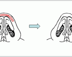 蒜頭鼻隆鼻 蒜頭鼻隆鼻