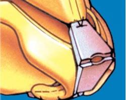 韓式隆鼻 韓式隆鼻