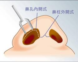 內開式與外開式隆鼻